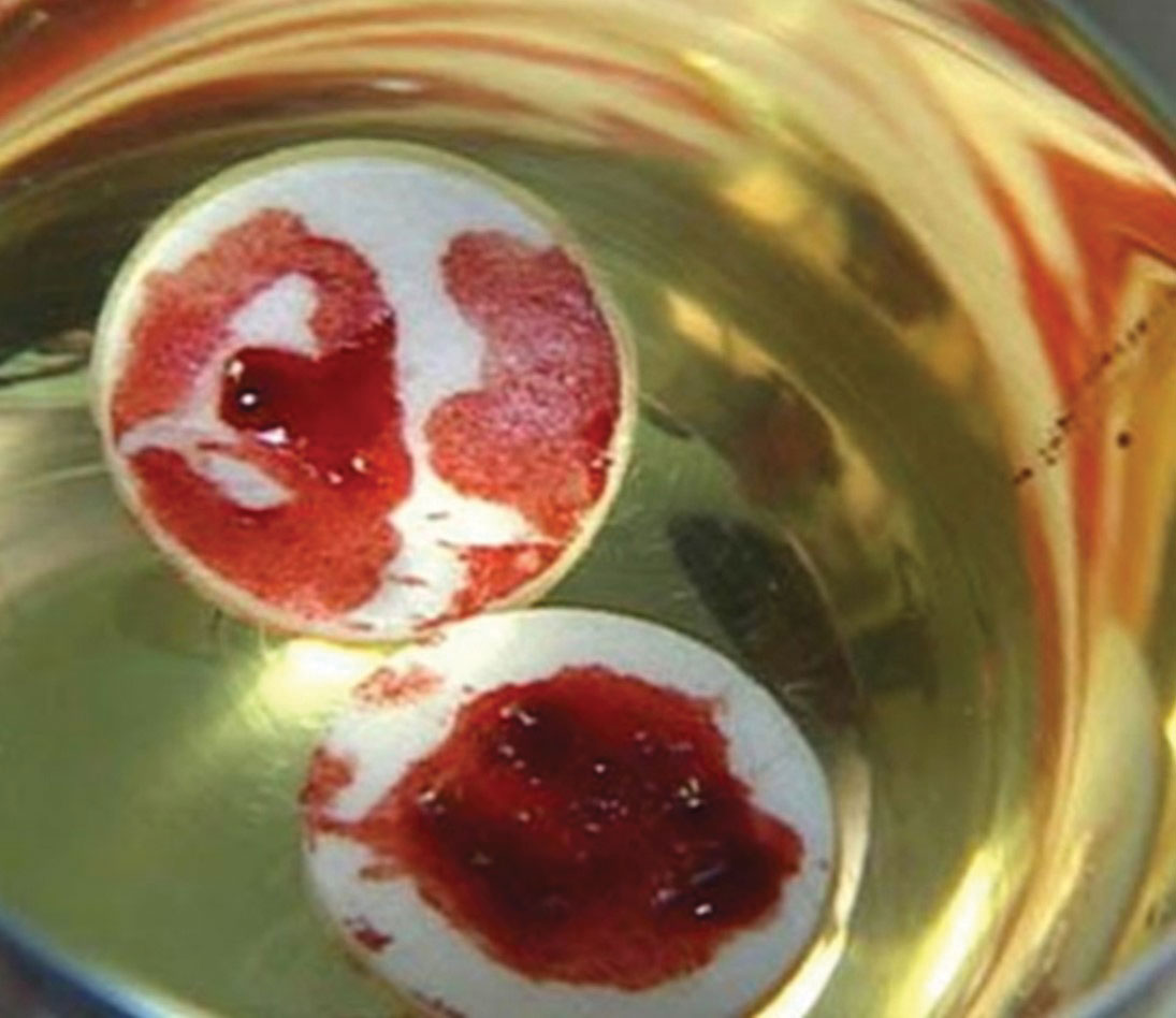Argentina eucharistic miracle bloody host